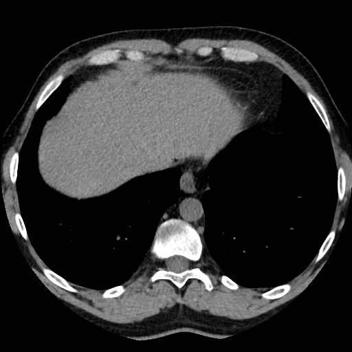 Adrenal gland trauma (Radiopaedia 81351-95079 Axial non-contrast 11).jpg