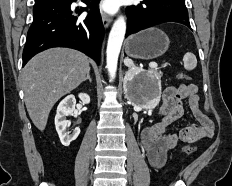 File:Adrenal metastases (Radiopaedia 73082-83791 Coronal C+ arterial phase 40).jpg