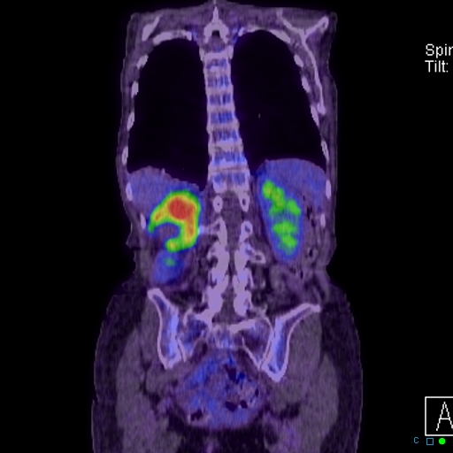 File:Adrenal metastasis from small cell lung cancer (Radiopaedia 19133-19109 Coronal 25).jpg