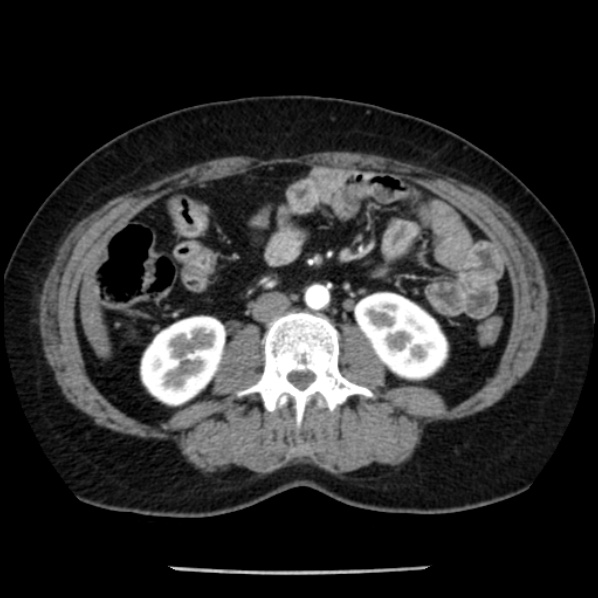 File:Adrenal myelolipoma (Radiopaedia 43401-46759 Axial C+ arterial phase 53).jpg