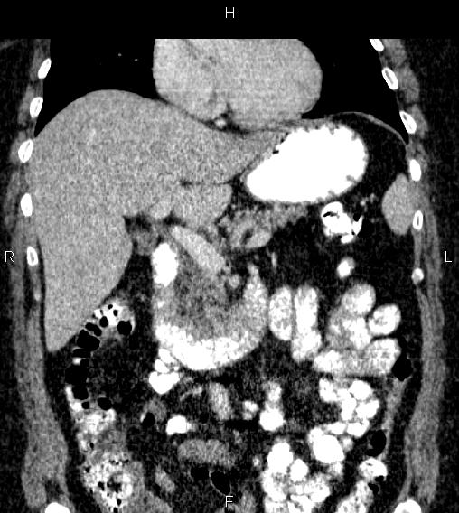 Adrenal myelolipoma (Radiopaedia 84319-99617 Coronal renal cortical phase 33).jpg