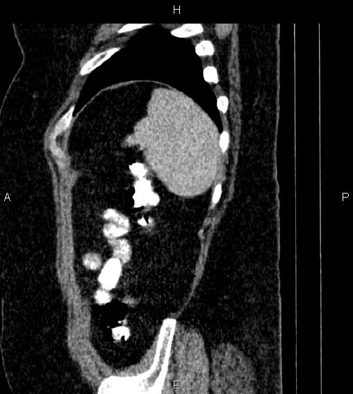 Adrenal myelolipoma (Radiopaedia 84319-99617 Sagittal renal cortical phase 85).jpg