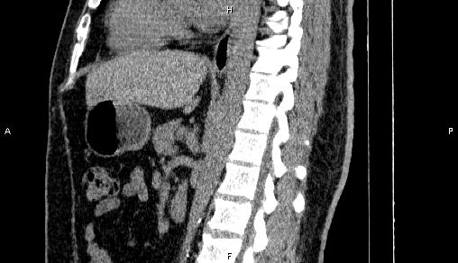 Adrenal myelolipoma (Radiopaedia 84321-99619 Sagittal non-contrast 58).jpg