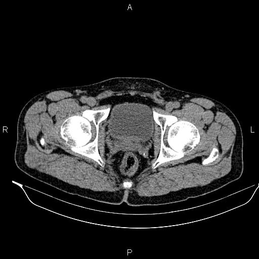 Adrenal myelolipoma (Radiopaedia 87794-104246 Axial non-contrast 103).jpg