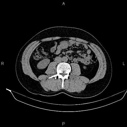 Adrenal myelolipoma (Radiopaedia 87794-104246 Axial non-contrast 57).jpg