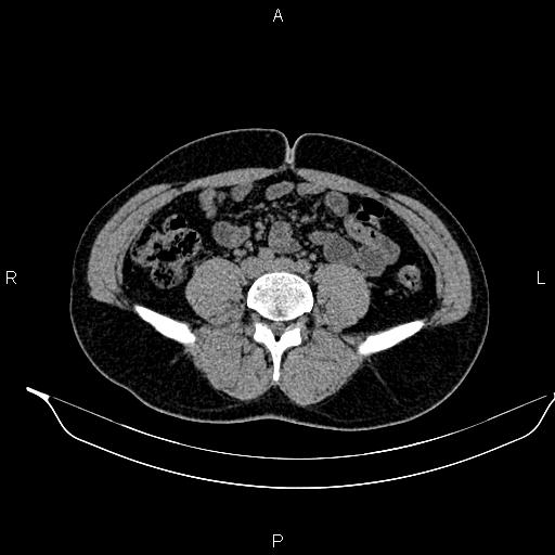 Adrenal myelolipoma (Radiopaedia 87794-104246 Axial non-contrast 67).jpg