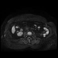File:Adrenal myelolipoma - MRI (Radiopaedia 83249-97646 Axial DWI 23).jpg