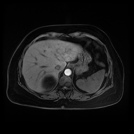 Adrenal myelolipoma - MRI (Radiopaedia 83249-97646 Axial T1 fat sat 11).jpg