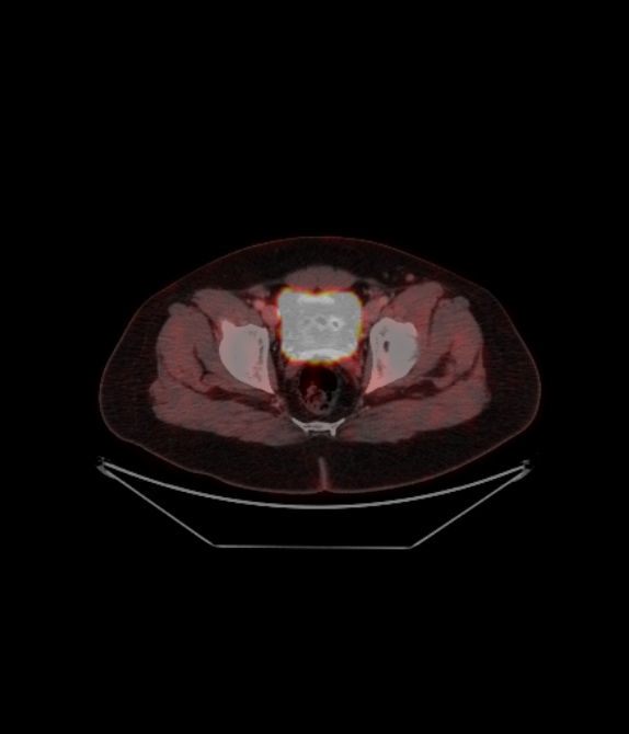 Adrenocortical carcinoma (Radiopaedia 80134-93440 ِAxial 244).jpg