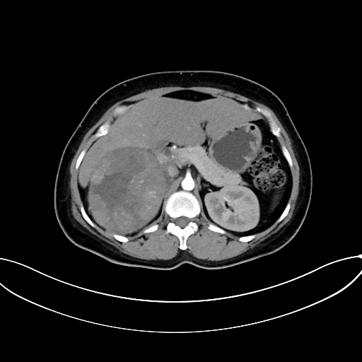 Adrenocortical carcinoma (Radiopaedia 87281-103569 Axial C+ arterial phase 31).jpg