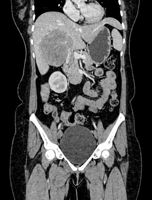 Adrenocortical carcinoma (Radiopaedia 87281-103569 Coronal C+ portal venous phase 28).jpg