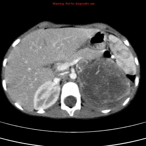 File:Adrenocortical carcinoma (Radiopaedia 9449-10131 Axial C+ portal venous phase 17).jpg