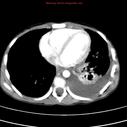 File:Adrenocortical carcinoma (Radiopaedia 9449-10131 Axial C+ portal venous phase 2).jpg