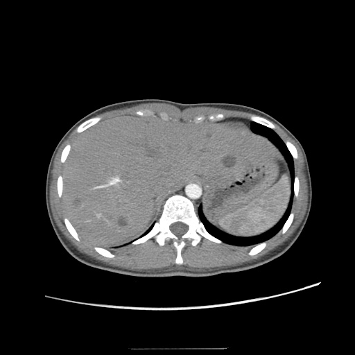 Adult polycystic kidney disease (Radiopaedia 48845-53876 Axial renal cortical phase 3).jpg