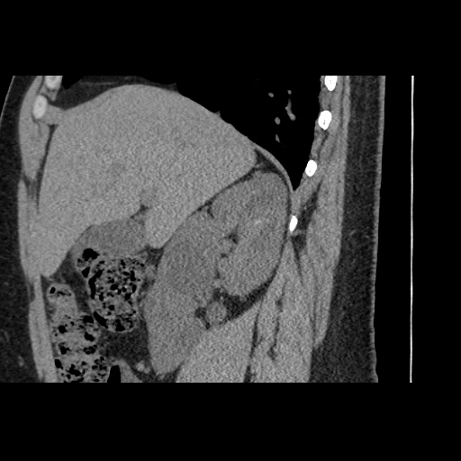 Adult polycystic kidney disease (Radiopaedia 59075-66368 Sagittal non-contrast 23).jpg