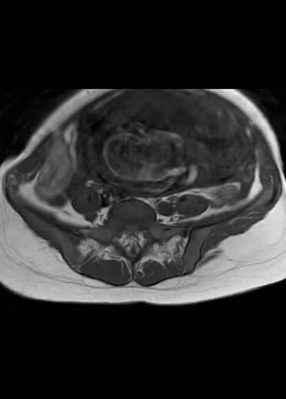 File:Aggressive angiomyxoma of the pelvis and perineum (Radiopaedia 59162-66479 T1 25).jpg