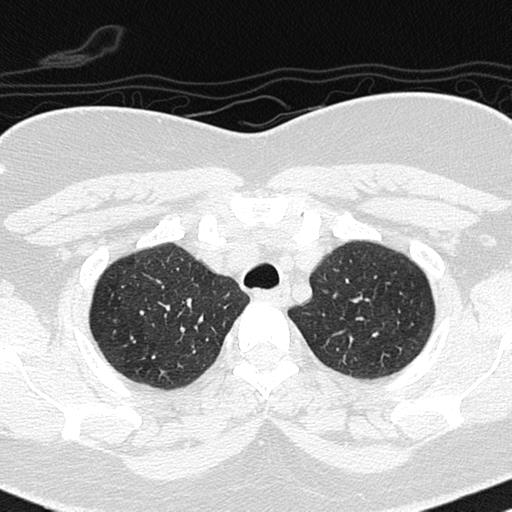 Air trapping in small airway disease (Radiopaedia 61685-69694 Axial lung window 30).jpg