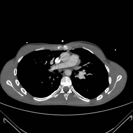 File:Alagille syndrome with pulmonary hypertension (Radiopaedia 49384-54980 A 5).jpg