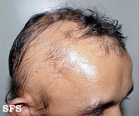Alopecia Areata (Dermatology Atlas 6).jpg