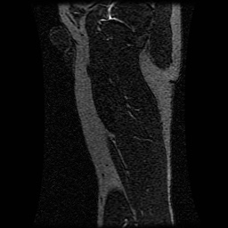 Alveolar soft part sarcoma (Radiopaedia 64501-73678 D 35).jpg