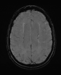 File:Alzheimer's disease- with Gerstmann syndrome and dressing apraxia (Radiopaedia 54882-61150 Axial SWI 23).png