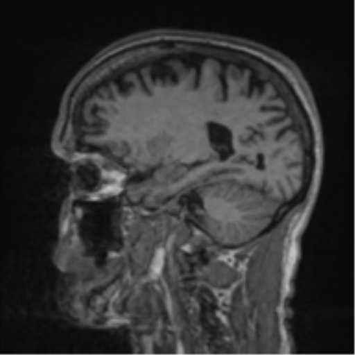File:Alzheimer's disease- with apraxia (Radiopaedia 54763-61011 Sagittal T1 47).png