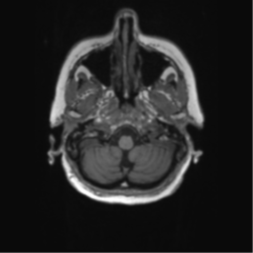 File:Alzheimer's disease (Radiopaedia 42658-45802 Axial T1 132).png