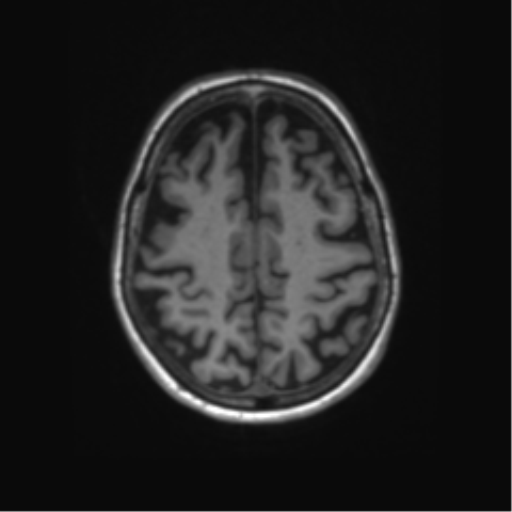 File:Alzheimer's disease (Radiopaedia 42658-45802 Axial T1 45).png