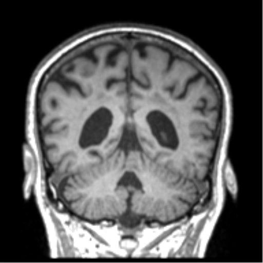 File:Alzheimer disease and cerebral amyloid angiopathy (Radiopaedia 64234-73011 Coronal T1 17).png