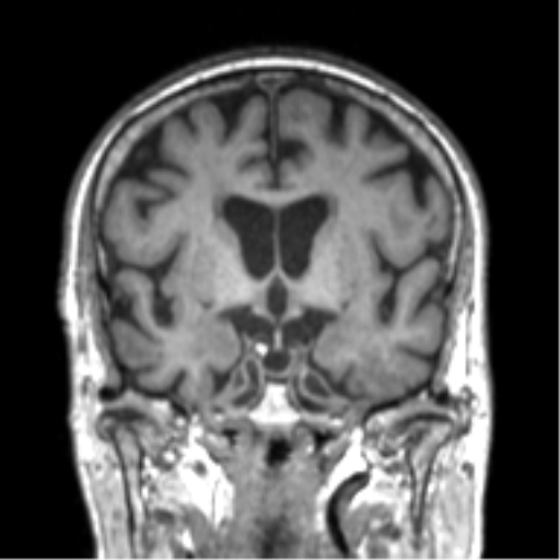 Alzheimer disease and cerebral amyloid angiopathy (Radiopaedia 64234-73011 Coronal T1 39).png