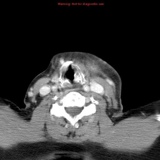 File:Ameloblastoma (Radiopaedia 27437-27631 A 66).jpg
