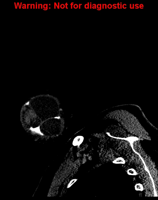 Ameloblastoma (Radiopaedia 33126-34164 F 7).jpg
