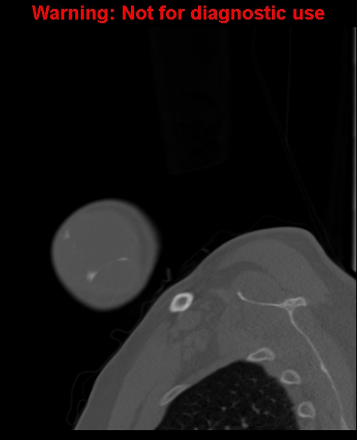 Ameloblastoma (Radiopaedia 33126-34164 Sagittal bone window 9).jpg