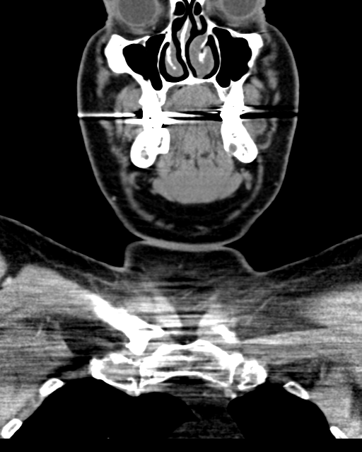 Ameloblastoma (Radiopaedia 38520-40623 Coronal non-contrast 23).png