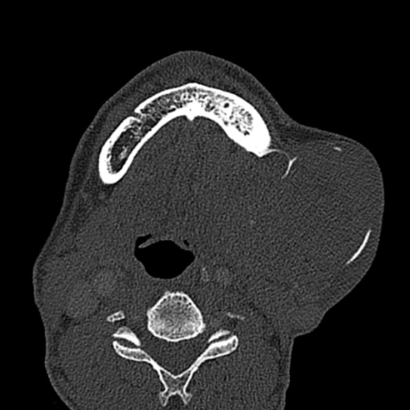 Ameloblastoma (Radiopaedia 51921-57766 Axial bone window 38).jpg