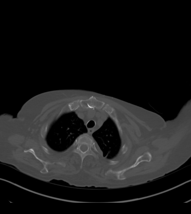 Amiodarone deposition in the liver (Radiopaedia 77587-89780 Axial bone window 15).jpg