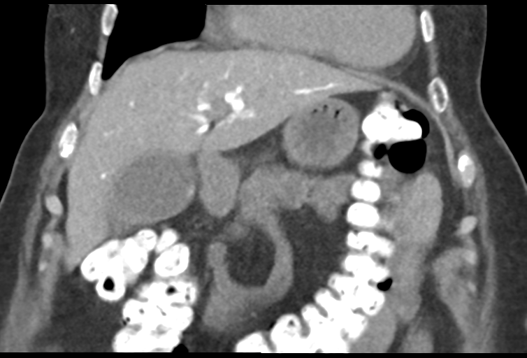 Ampullary adenocarcinoma (Radiopaedia 34013-35241 Coronal 14).png