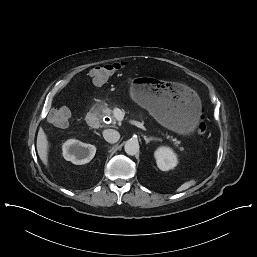 Ampullary adenocarcinoma (Radiopaedia 59373-66737 A 59).jpg