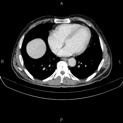 Ampullary adenocarcinoma (Radiopaedia 86093-102032 A 5).jpg