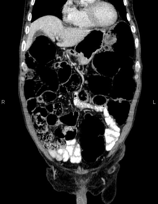 Ampullary adenocarcinoma (Radiopaedia 86093-102032 C 17).jpg