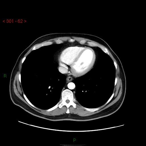 Ampullary carcinoma (Radiopaedia 56396-63056 B 8).jpg