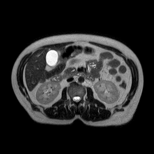 File:Ampullary tumor (Radiopaedia 27294-27479 T2 3).jpg
