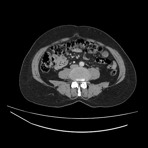 File:Ampullary tumor (Radiopaedia 60333-67998 A 49).jpg