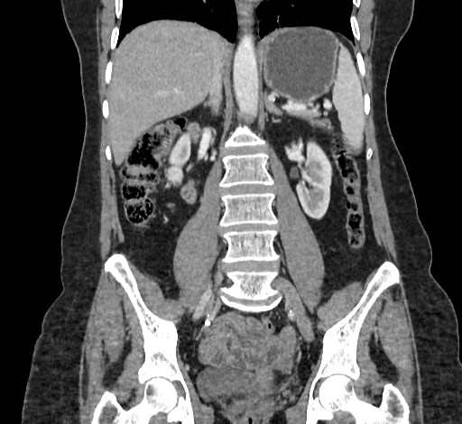 Ampullary tumor (Radiopaedia 60333-67998 B 46).jpg