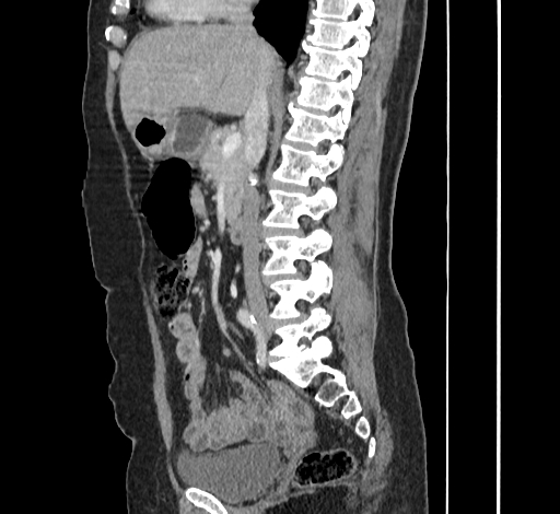 Ampullary tumor (Radiopaedia 60333-67998 C 26).jpg