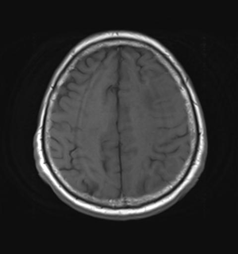 File:Amyloid angiopathy with inflammation (Radiopaedia 30360-31002 Axial T1 25).jpg