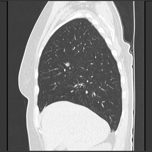 Amyloidosis - bronchial and diffuse nodular pulmonary involvement (Radiopaedia 60156-67744 F 14).jpg