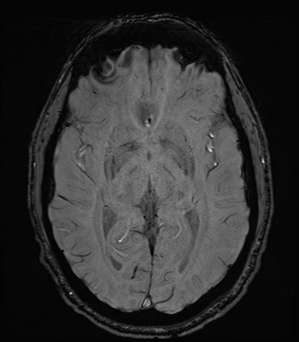 Amyotrophic lateral sclerosis (Radiopaedia 87352-103658 Axial SWI 26).jpg