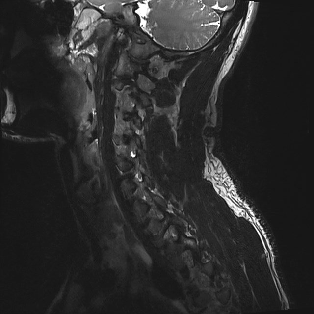 Amyotrophic lateral sclerosis (Radiopaedia 87352-103658 I 50).jpg