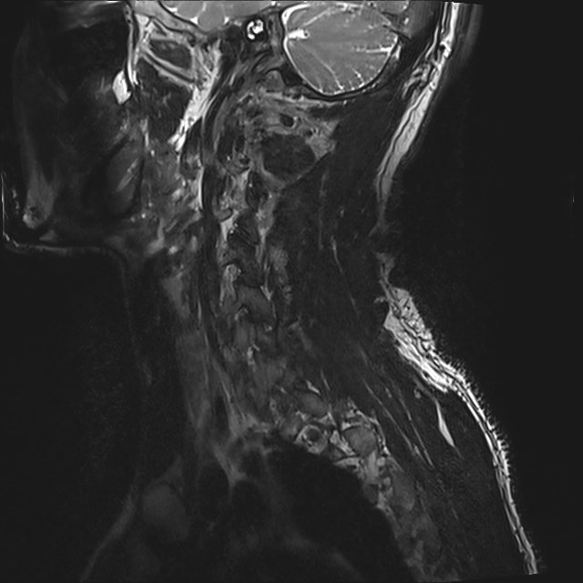 Amyotrophic lateral sclerosis (Radiopaedia 87352-103658 I 63).jpg